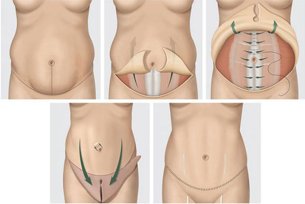 Que sucede durante la abdominoplastia?, Abdominoplastía