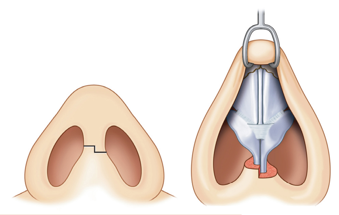 rinoplastia abierta